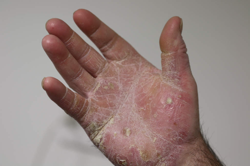 Mycoses de la main, consulter les spécialistes pour se faire traiter