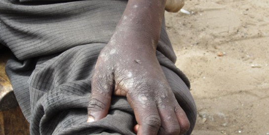 La gale, une maladie qui sévit toujours au Burkina Faso