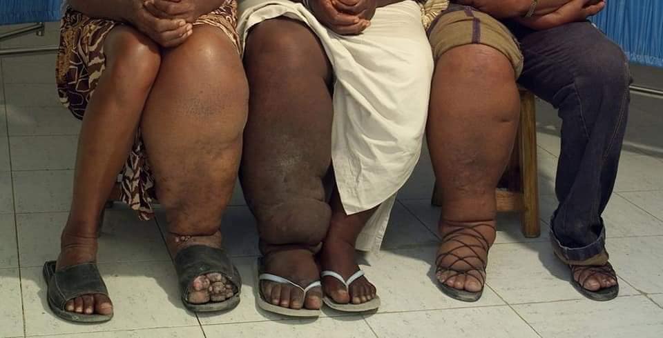 Comment lutter contre l’éléphantiasis