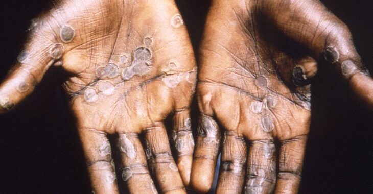 Variole du singe : comprendre la transmission, les symptômes et la prévention