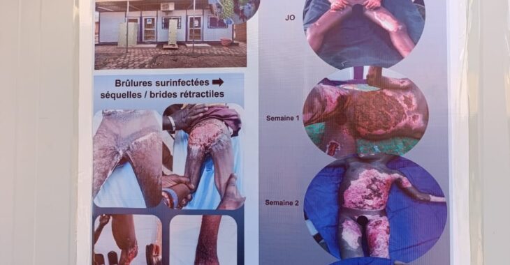 Des difficultés dans la prise en charge des brûlés à la Pédiatrie Charles De Gaulle