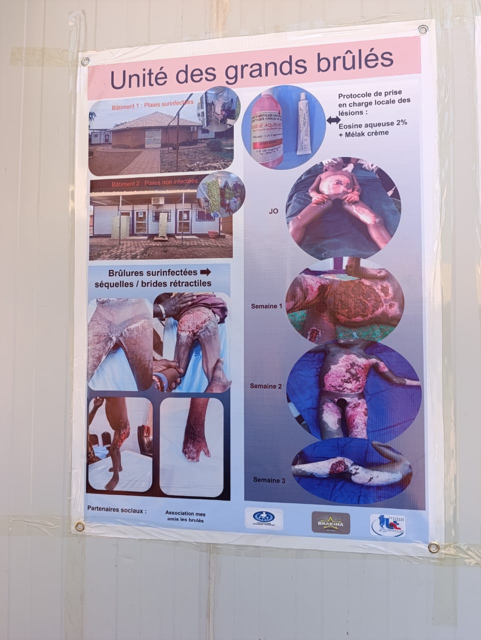 Des difficultés dans la prise en charge des brûlés  à la Pédiatrie Charles De Gaulle